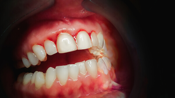 Bleeding Gums 1 Hnet.com image 25