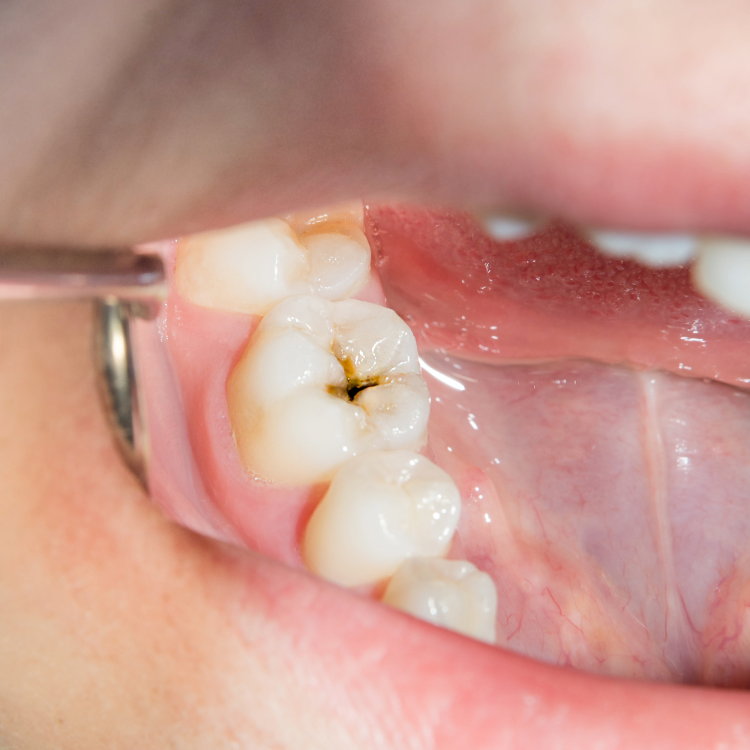 Tooth Decay