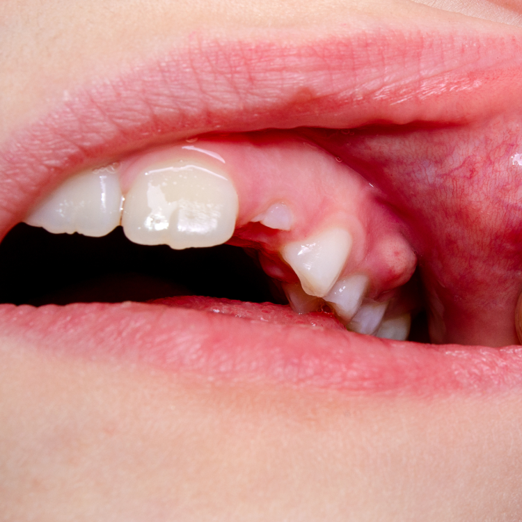 Dental Abscess
