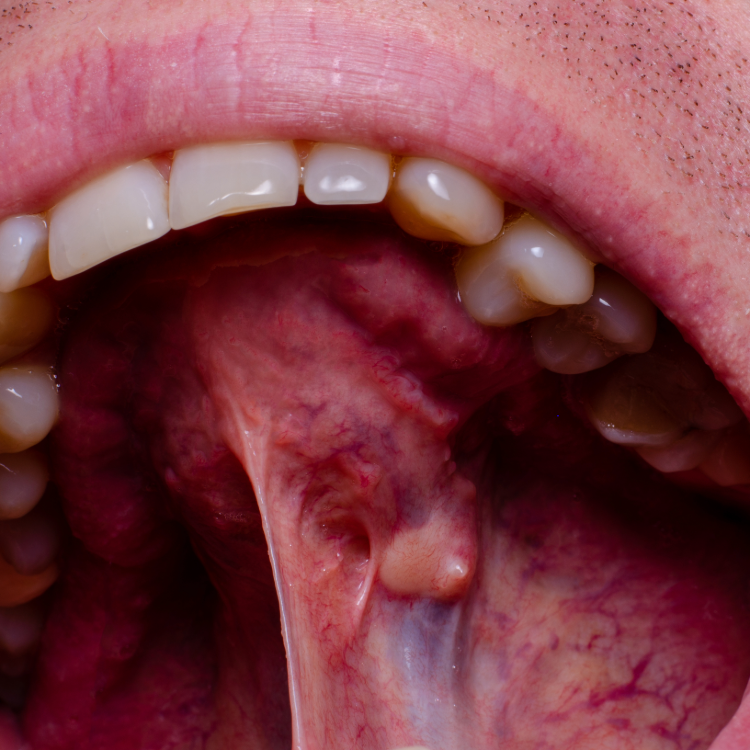 Dental Cysts