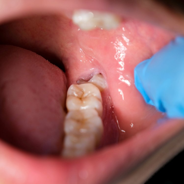 Infected Wisdom Teeth