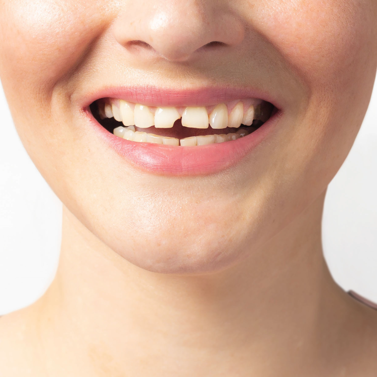 Chipped tooth