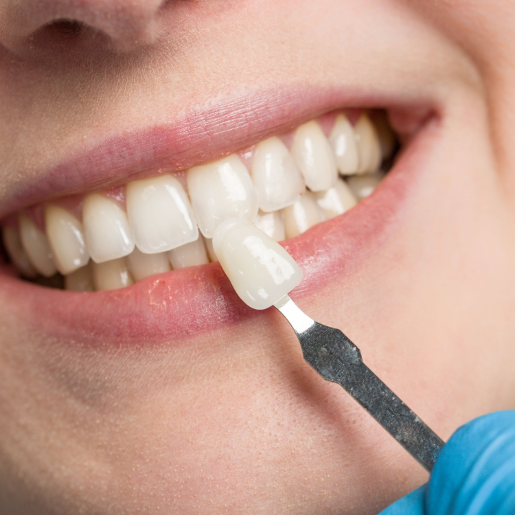 Loose or Broken Veneer